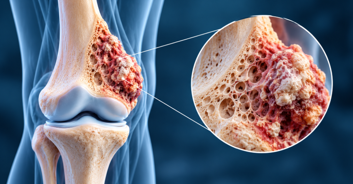 Osteosarkom